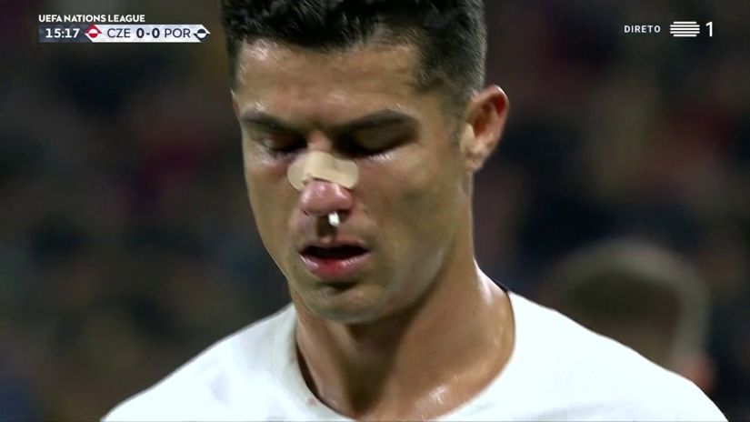 Les nouvelles de Cristiano Ronaldo après son gros choc au nez